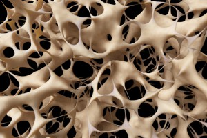 osteoporosis - unhealthy bone structure